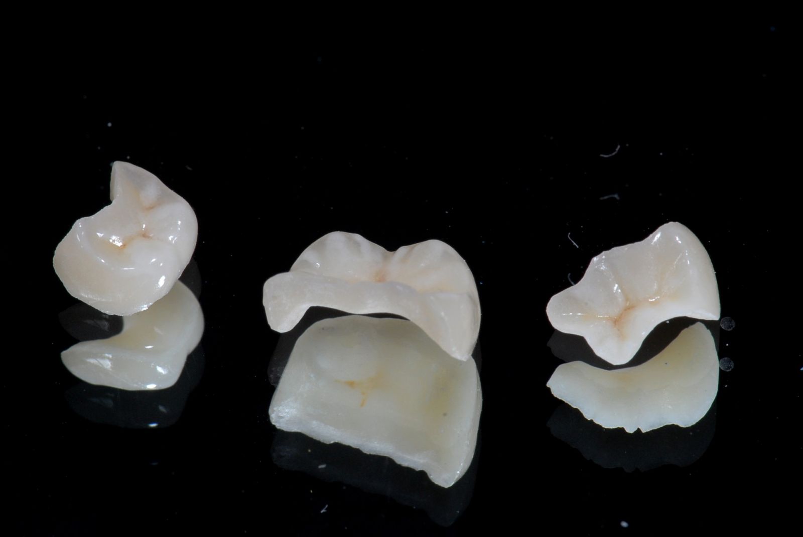 Керамические зубные вкладки разновидности